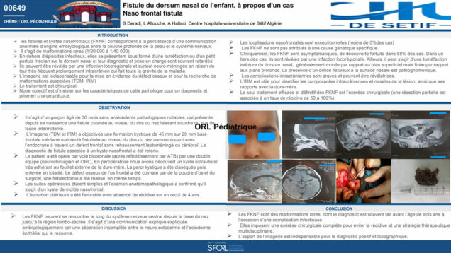 603_SALAH-EDDINE_DERADJ_P151—Fistules-du-dorsum-nasal-de-lenfant,-à-propos-dun-cas