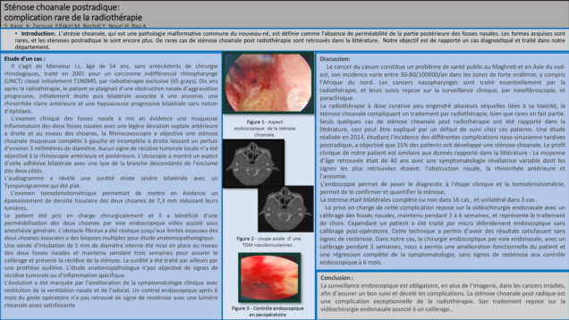 688_Kajai_Soufiyane_P236-Stenose-choanale-postradique-complication-rare-de-la-radiotherapie