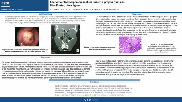 690_younes_hussein_P238-Adenome-pleiomorphe-du-septum-nasal-a-propos-dun-cas